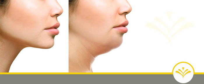 Kybella Treatment Specialist Near Me in Newington NH Kybella Treatment Specialist Near Me in Newington NH