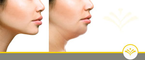 Kybella Treatment Specialist Near Me in Newington NH Kybella Treatment Specialist Near Me in Newington NH