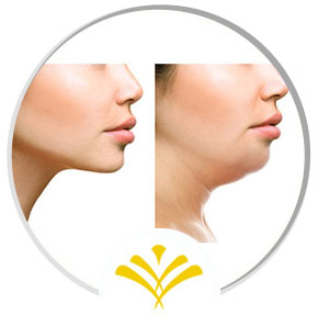Kybella Injections Specialist Near Me in Newington NH