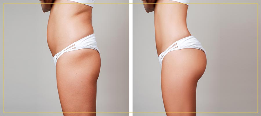 Coolsculpting Results Near Me in Newington NH