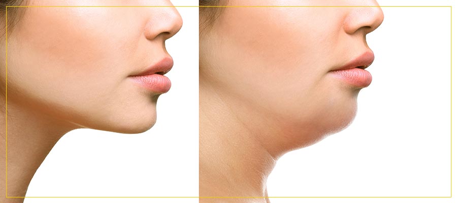 Kybella Treatment Specialist Near Me in Newington NH Kybella Treatment Specialist Near Me in Newington NH
