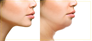 Kybella Treatment Specialist Near Me in Newington NH